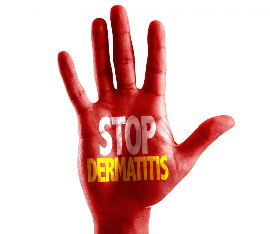 Jak léčit postradiační dermatitidu?
